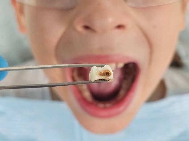 Best Urgent Care for Lost Fillings or Crowns in Honeygo, MD